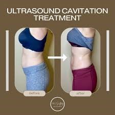 Cavitation treatment  